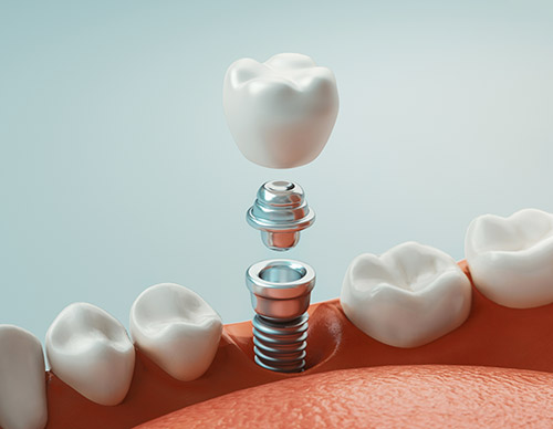 Oyster Point Dental - Dental Implant