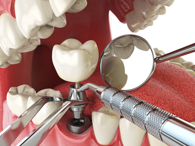 Oyster Point Dental - Dental Implants