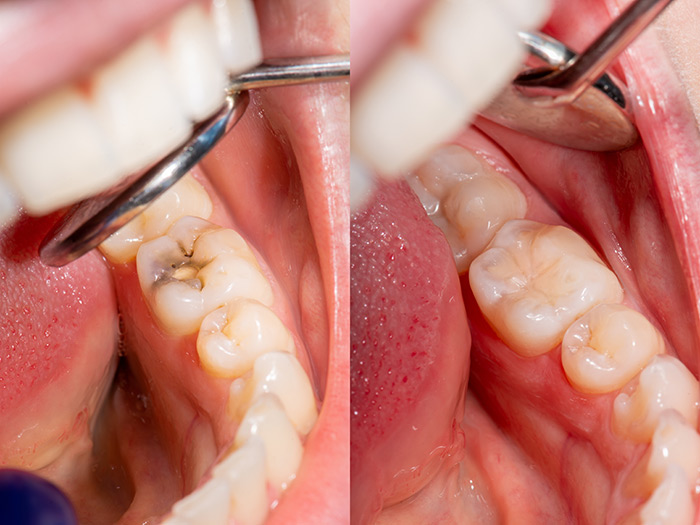 Oyster Point Dental - Invisible Dental Filling