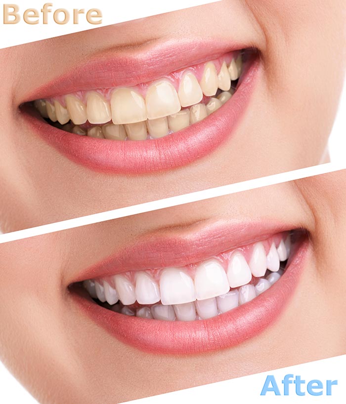 Oyster Point Dental - Britesmile teeth whitening system