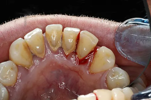Oyster Point Dental - Why Bleeding Gums Shouldn’t Be Ignored
