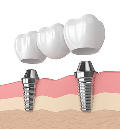 Oyster Point Dental - Dental Bridges