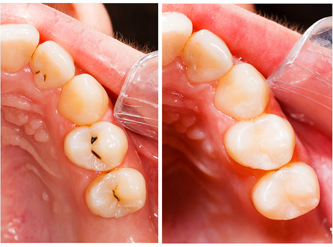 Oyster Point Dental - Invisible Fillings