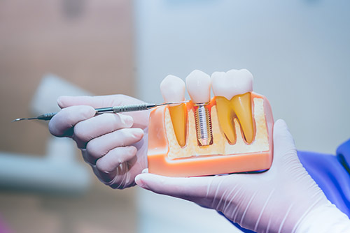 Oyster Point Dentistry - Dental Implants