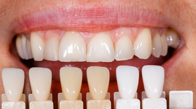 Oyster Point Dentistry - Dental Veneers in Newport News, VA