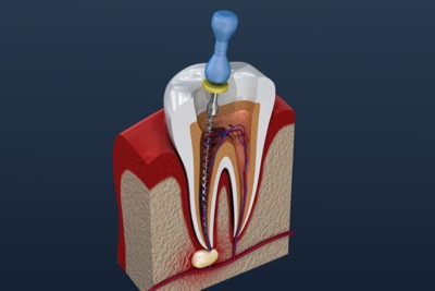 Oyster Point Dentistry, Newport News, VA - Root Canal Treatment